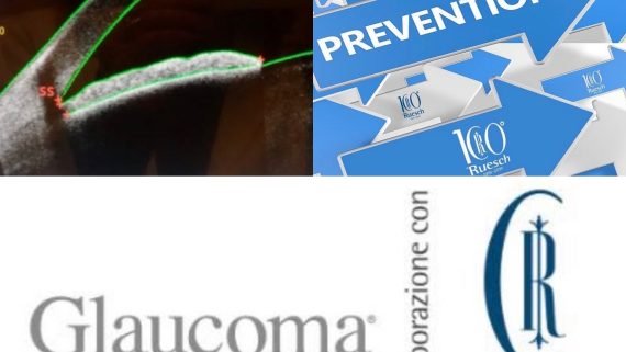Glaucoma Advanced Care Napoli