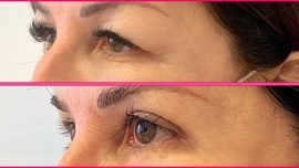 Blefaroplastica della palpebra napoli