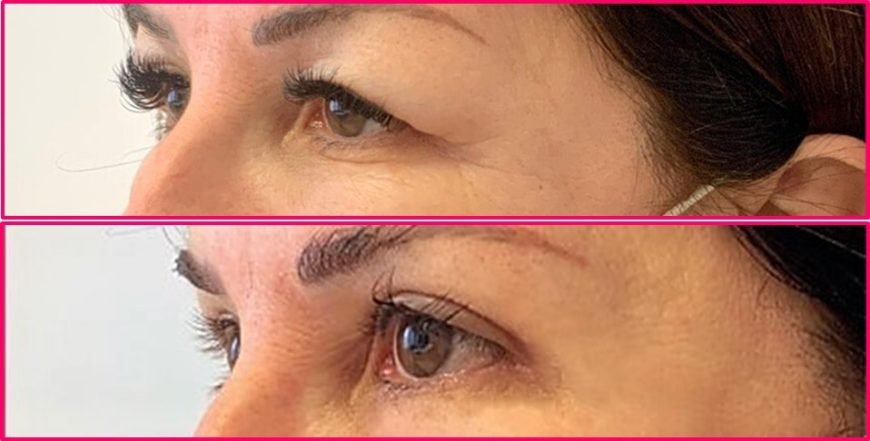 Blefaroplastica della palpebra napoli