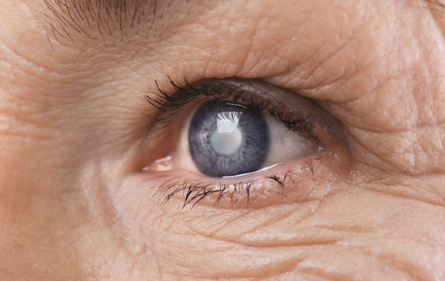Retinopatia Diabetica Napoli